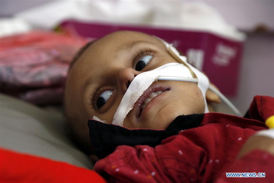 YEMEN-SANAA-CHILDREN-MALNUTRITION